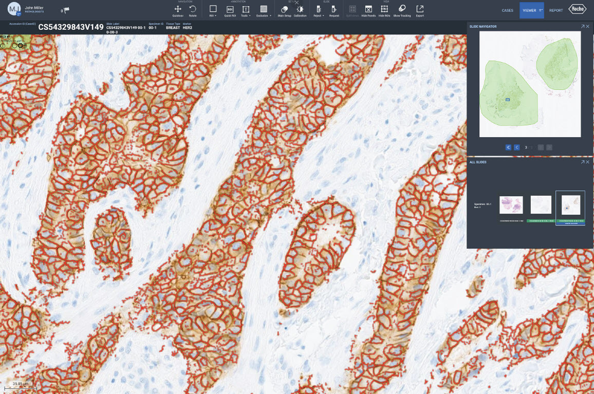 uPath HER2 (4B5) image analysis, Breast, product image